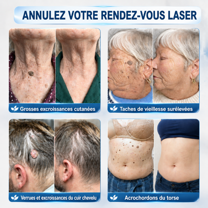 👩‍⚕️🎁 𝐵𝑜𝑢𝑡𝑖𝑞𝑢𝑒 𝑂𝑓𝑓𝑖𝑐𝑖𝑒𝑙𝑙𝑒 | 𝑵𝐞𝒌𝐢𝐬𝐬® 🌿𝑴𝒊𝒄𝒓𝒐𝒏𝒆𝒆𝒅𝒍𝒆𝒔 𝑷𝒆𝒂𝒖 𝑷𝒂𝒓𝒇𝒂𝒊𝒕𝒆 É𝒍𝒊𝒎𝒊𝒏𝒂𝒕𝒊𝒐𝒏 𝑫𝒆𝒔 𝑽𝒆𝒓𝒓𝒖𝒆𝒔 𝑷𝒂𝒕𝒄𝒉 (𝑃𝑜𝑢𝑟 𝑙𝑒𝑠 𝑎𝑐𝑟𝑜𝑐ℎ𝑜𝑟𝑑𝑜𝑛𝑠, 𝑙𝑒𝑠 𝑝𝑒𝑡𝑖𝑡𝑒𝑠 𝑒𝑥𝑐𝑟𝑜𝑖𝑠𝑠𝑎𝑛𝑐𝑒𝑠 𝑐𝑢𝑡𝑎𝑛é𝑒𝑠, 𝑙𝑒𝑠 𝑣𝑒𝑟𝑟𝑢𝑒𝑠, 𝑙𝑒𝑠 𝑔𝑟𝑎𝑖𝑛𝑠 𝑑𝑒 𝑏𝑒𝑎𝑢𝑡é, 𝑙𝑒𝑠 𝑡𝑎𝑐ℎ𝑒𝑠 𝑑𝑒 𝑣𝑖𝑒𝑖𝑙𝑙𝑒𝑠𝑠𝑒 𝑒𝑡 𝑙𝑒𝑠 𝑝𝑟𝑜𝑏𝑙è𝑚𝑒𝑠 𝑑𝑒 𝑝𝑖𝑔𝑚𝑒𝑛𝑡𝑎𝑡𝑖𝑜𝑛)