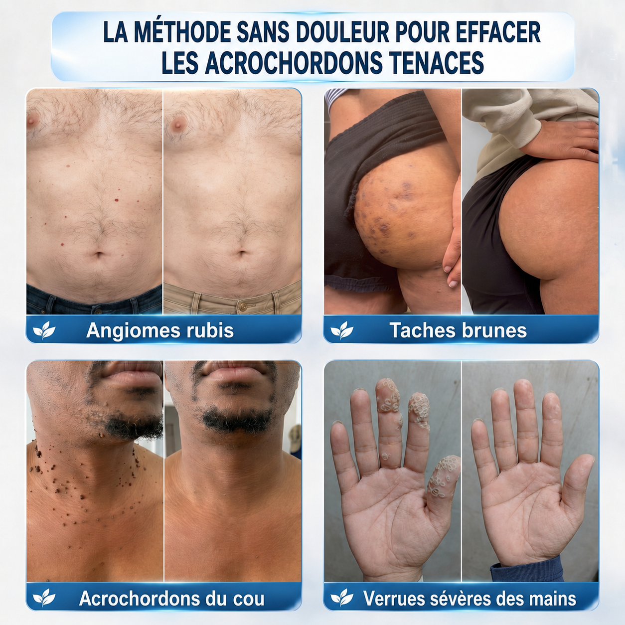 👩‍⚕️🎁 𝐵𝑜𝑢𝑡𝑖𝑞𝑢𝑒 𝑂𝑓𝑓𝑖𝑐𝑖𝑒𝑙𝑙𝑒 | 𝑵𝐞𝒌𝐢𝐬𝐬® 🌿𝑴𝒊𝒄𝒓𝒐𝒏𝒆𝒆𝒅𝒍𝒆𝒔 𝑷𝒆𝒂𝒖 𝑷𝒂𝒓𝒇𝒂𝒊𝒕𝒆 É𝒍𝒊𝒎𝒊𝒏𝒂𝒕𝒊𝒐𝒏 𝑫𝒆𝒔 𝑽𝒆𝒓𝒓𝒖𝒆𝒔 𝑷𝒂𝒕𝒄𝒉 (𝑃𝑜𝑢𝑟 𝑙𝑒𝑠 𝑎𝑐𝑟𝑜𝑐ℎ𝑜𝑟𝑑𝑜𝑛𝑠, 𝑙𝑒𝑠 𝑝𝑒𝑡𝑖𝑡𝑒𝑠 𝑒𝑥𝑐𝑟𝑜𝑖𝑠𝑠𝑎𝑛𝑐𝑒𝑠 𝑐𝑢𝑡𝑎𝑛é𝑒𝑠, 𝑙𝑒𝑠 𝑣𝑒𝑟𝑟𝑢𝑒𝑠, 𝑙𝑒𝑠 𝑔𝑟𝑎𝑖𝑛𝑠 𝑑𝑒 𝑏𝑒𝑎𝑢𝑡é, 𝑙𝑒𝑠 𝑡𝑎𝑐ℎ𝑒𝑠 𝑑𝑒 𝑣𝑖𝑒𝑖𝑙𝑙𝑒𝑠𝑠𝑒 𝑒𝑡 𝑙𝑒𝑠 𝑝𝑟𝑜𝑏𝑙è𝑚𝑒𝑠 𝑑𝑒 𝑝𝑖𝑔𝑚𝑒𝑛𝑡𝑎𝑡𝑖𝑜𝑛)